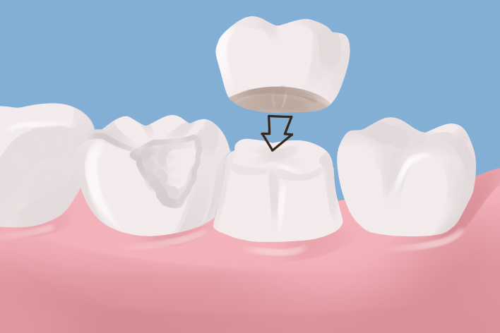 tooth crown example