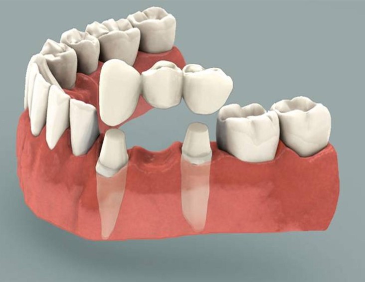 dental bridge example