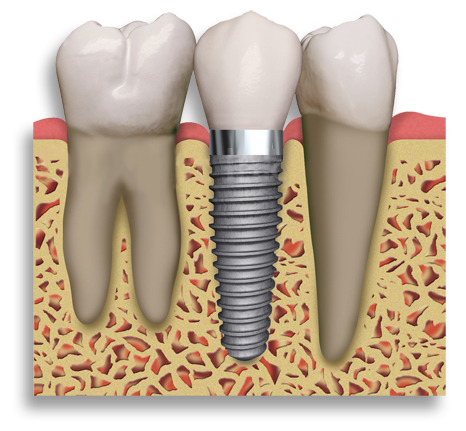 example of dental implant