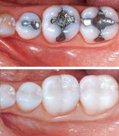 restoration of tooth